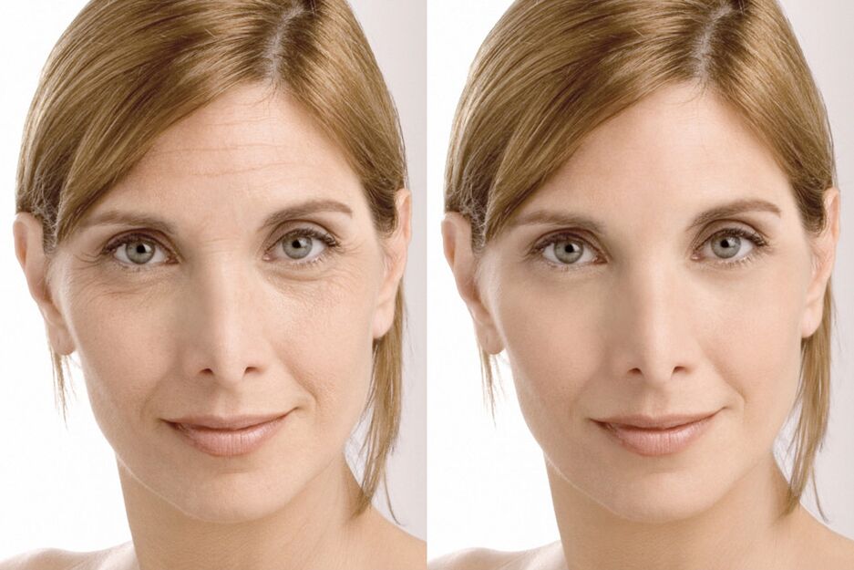 Experience of use before and after cream intenskin from Milana