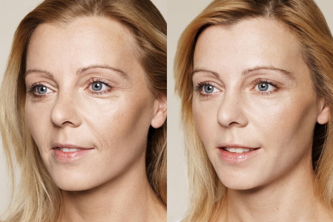 Experience of use before and after use of cream intenskin by Valeria